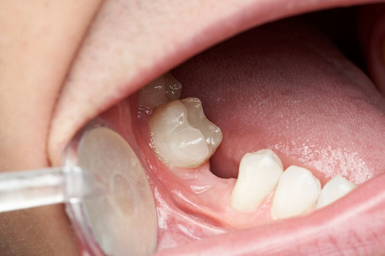 歯が抜けた本数やお口の状態で適切な治療法が変わります