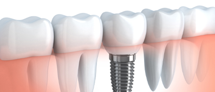 インプラント治療について