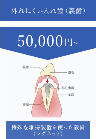 外れにくい入れ歯（義歯）