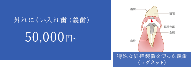 外れにくい入れ歯（義歯）